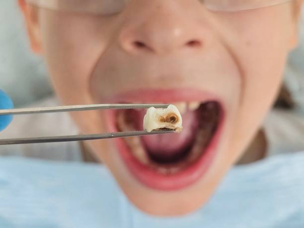 Best Urgent Care for Lost Fillings or Crowns in Spring Grove, IL